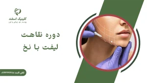 دوره نقاهت لیفت با نخ