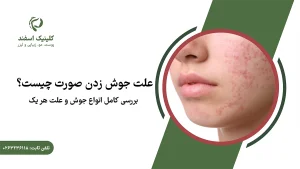 علت جوش زدن صورت