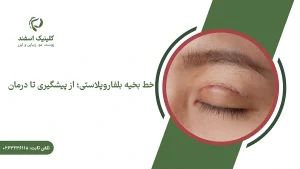خط بخیه بلفاروپلاستی