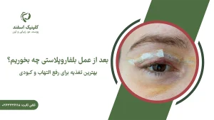 بعد از عمل بلفاروپلاستی چه بخوریم؟ بهترین تغذیه برایرفع التهاب و کبودی