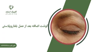 گوشت اضافه بعد از عمل بلفاروپلاستی در گوشه چشم یک خانم